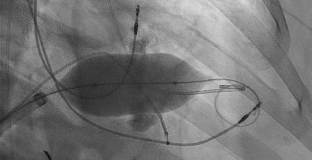 Imagen: Una técnica mínimamente invasiva se ofrece como opción de tratamiento prometedora y segura para pacientes con estenosis mitral severa (Fotografía cortesía de Eng, et al., JACC: Cardiovascular Interventions)